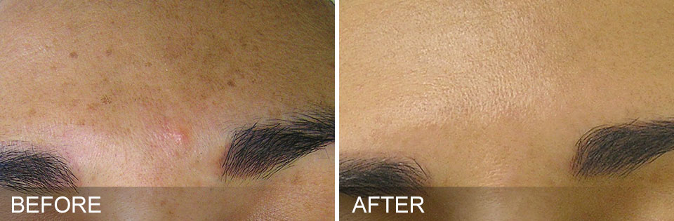 Before & After Brown Spots (1)